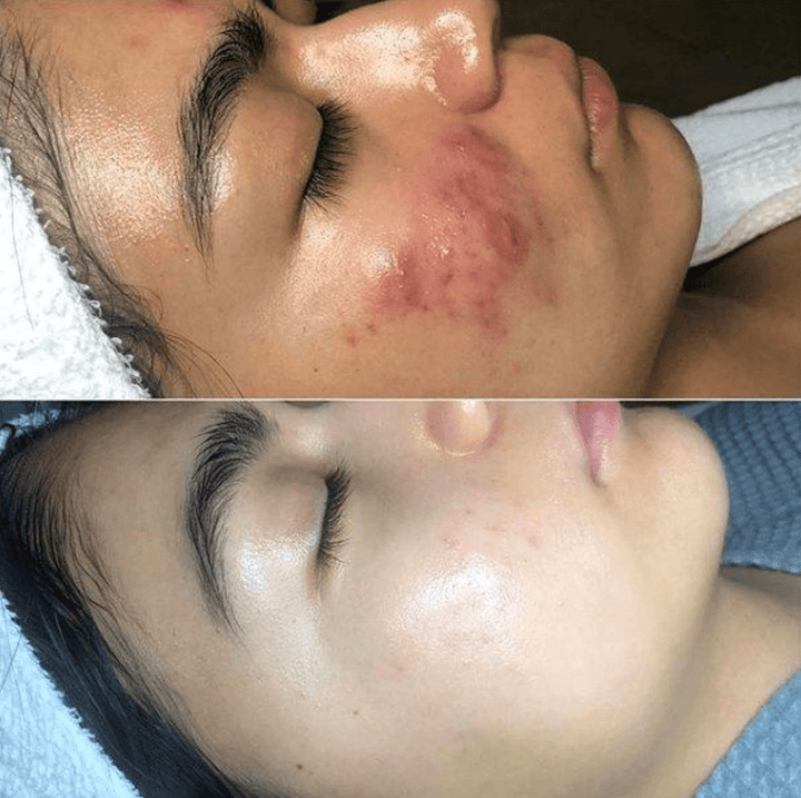 High-Frequency Skin Therapy Wand - GlowWave
