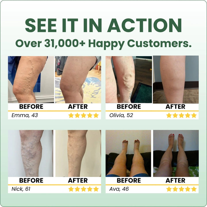Leg Swelling Cream with Horse Chestnut and Arnica Varicose Vein Balm