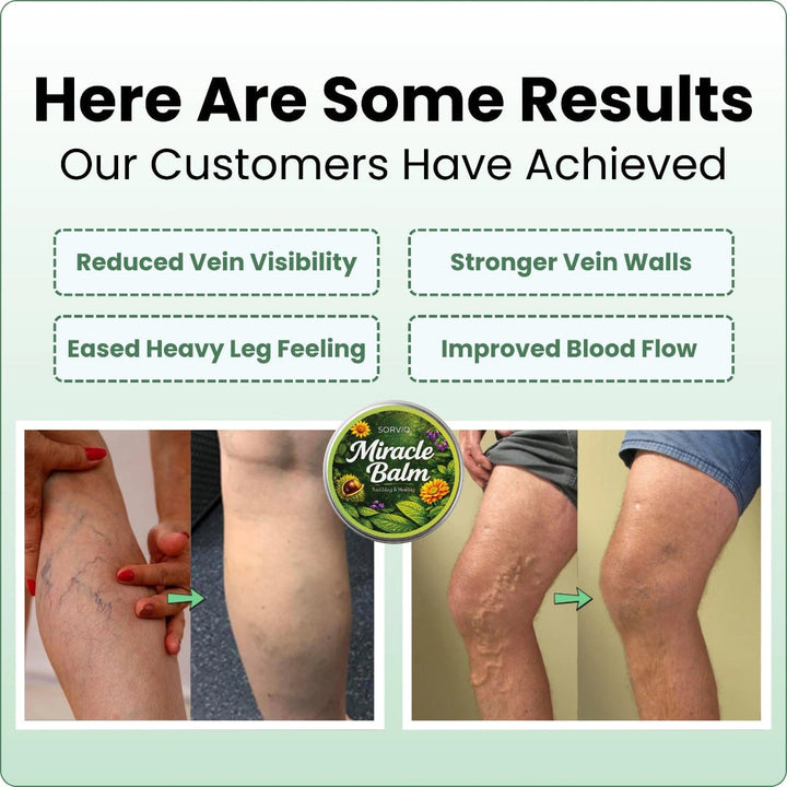 Leg Swelling Cream with Horse Chestnut and Arnica Varicose Vein Balm